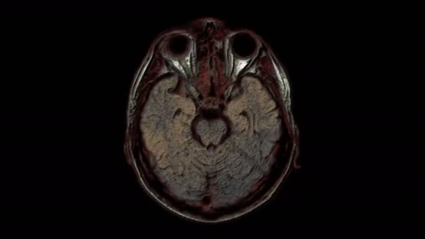 Ressonância magnética multicolorida em massa do cérebro e da cabeça para detectar tumores. Ferramenta médica de diagnóstico — Vídeo de Stock