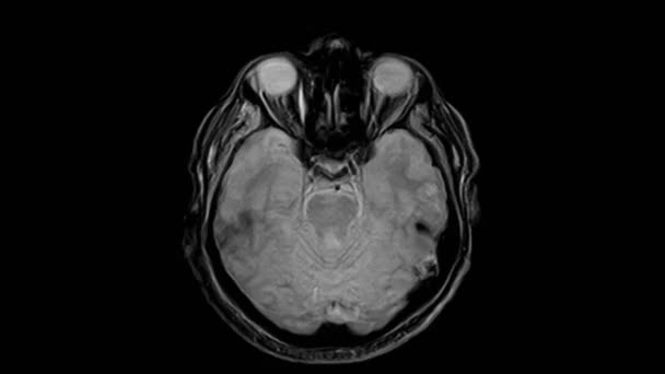 HersenMRI, hoofdscans en tumordetectie. Diagnostisch medisch hulpmiddel — Stockvideo