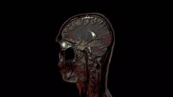 脳と頭のバルク多色MRIスキャンで腫瘍を検出します。診断医療ツール — ストック動画