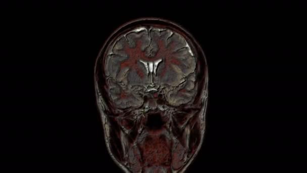 Resonancia magnética multicolor masiva del cerebro y la cabeza para detectar tumores. Herramienta médica de diagnóstico — Vídeo de stock