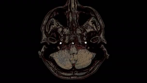 Rozsáhlé mnohobarevné snímky mozku a hlavy mri odhalují nádory. Diagnostický lékařský nástroj — Stock video