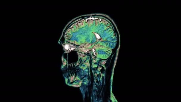 Bulk multicolored MRI scans of the brain and head to detect tumors. Diagnostic medical tool — Stock Video