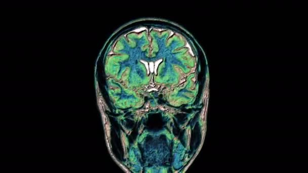 Bulk multicolored MRI scans of the brain and head to detect tumors. Diagnostic medical tool — Stock Video