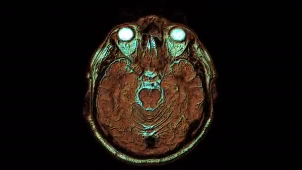 Luzem wielobarwne Mri skany mózgu i głowy w celu wykrycia guzów. Diagnostyczne narzędzie medyczne — Wideo stockowe