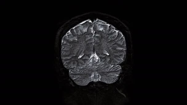 Resonancia magnética de color voluminoso del cerebro y la cabeza para detectar tumores. Herramienta médica de diagnóstico — Vídeo de stock