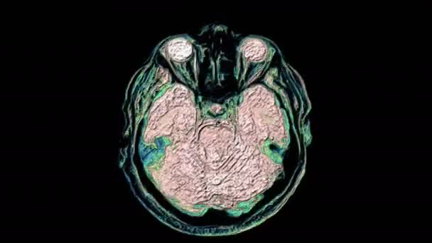 Bulk multicolored MRI scans of the brain and head to detect tumors. Diagnostic medical tool — Stock Video