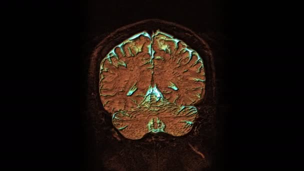 Massenhaft mehrfarbige MRI-Scans von Gehirn und Kopf, um Tumore zu erkennen. Diagnostisches medizinisches Werkzeug — Stockvideo