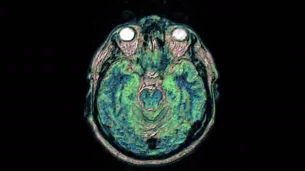 Massenhaft mehrfarbige MRI-Scans von Gehirn und Kopf, um Tumore zu erkennen. Diagnostisches medizinisches Werkzeug — Stockvideo