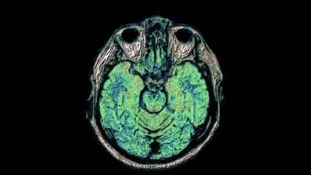 Resonancia magnética multicolor masiva del cerebro y la cabeza para detectar tumores. Herramienta médica de diagnóstico — Vídeo de stock