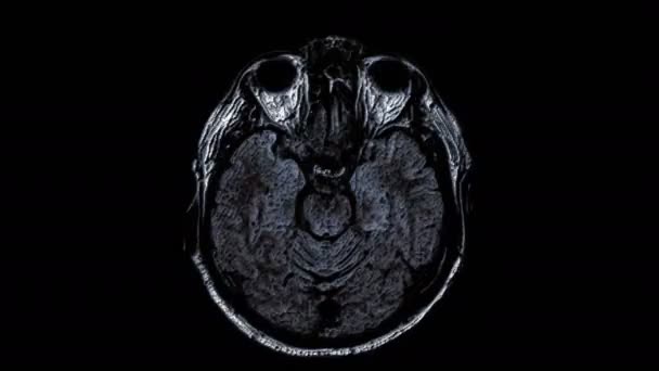 Ressonância magnética colorida volumosa do cérebro e da cabeça para detectar tumores. Ferramenta médica de diagnóstico — Vídeo de Stock