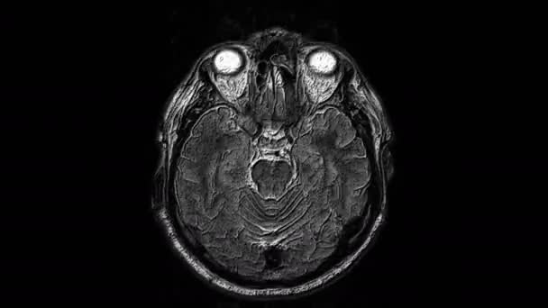 Ressonância magnética volumosa do cérebro e da cabeça para detectar tumores. Ferramenta médica de diagnóstico — Vídeo de Stock