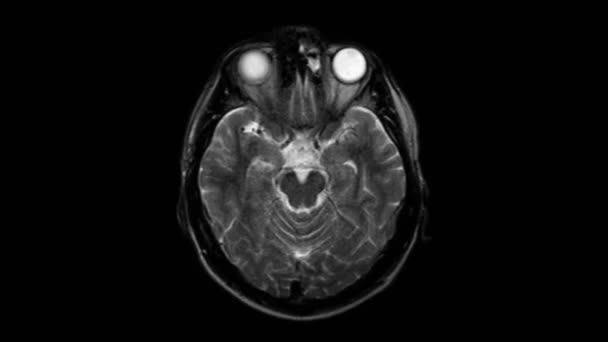 Beyin MR 'ı, kafa taraması ve tümör tespiti. Teşhis medikal aracı — Stok video