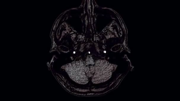 Ressonância magnética colorida volumosa do cérebro e da cabeça para detectar tumores. Ferramenta médica de diagnóstico — Vídeo de Stock