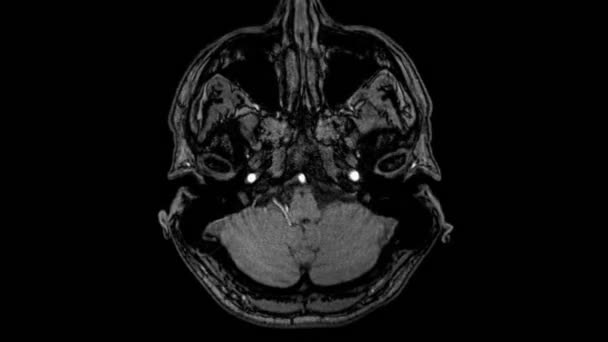 Brain MRI, head scans and tumor detection. Diagnostic medical tool — Stock Video