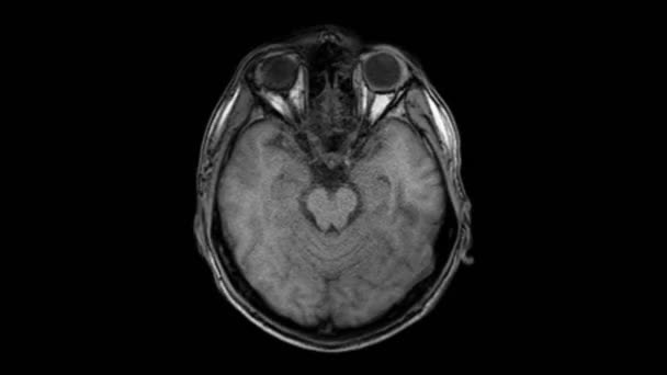 Resonancia magnética cerebral, escáneres de cabeza y detección de tumores. Herramienta médica de diagnóstico — Vídeo de stock