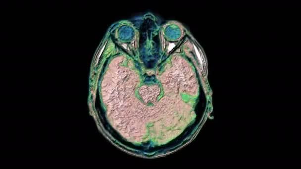 Навалочные многоцветные МРТ мозга и головы для обнаружения опухолей. Диагностический медицинский инструмент — стоковое видео