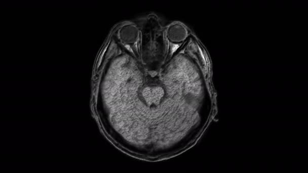 Une IRM volumineuse scanne le cerveau et la tête pour détecter les tumeurs. Outil médical diagnostique — Video