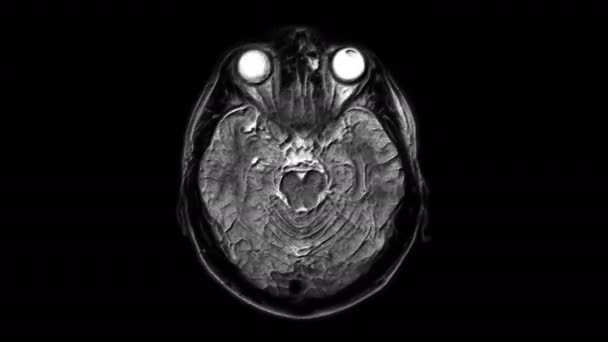 Une IRM volumineuse scanne le cerveau et la tête pour détecter les tumeurs. Outil médical diagnostique — Video