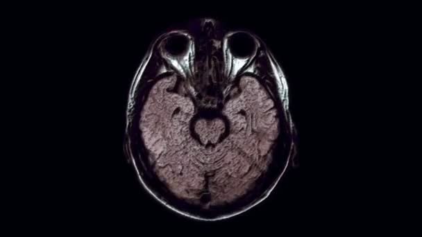 Ressonância magnética colorida volumosa do cérebro e da cabeça para detectar tumores. Ferramenta médica de diagnóstico — Vídeo de Stock