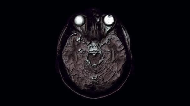 Resonancia magnética de color voluminoso del cerebro y la cabeza para detectar tumores. Herramienta médica de diagnóstico — Vídeo de stock