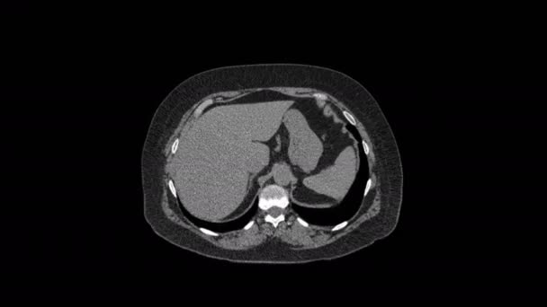 Resonancia magnética purificada del abdomen, tracto gastrointestinal, vejiga — Vídeo de stock