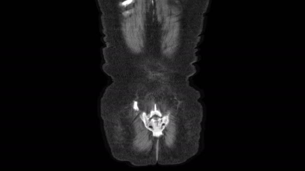 MRI břišní dutiny, gastrointestinálního traktu, močového měchýře — Stock video