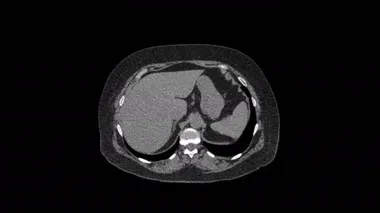 Karın boşluğunun MR 'ı, gastrointestinal bölge, mesane.