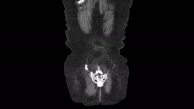 Karın, gastrointestinal bölge ve mesanenin saf MR 'ı.