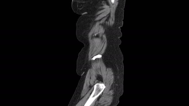 腹腔、消化管、膀胱のMRI — ストック動画