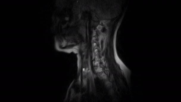 Mri van de wervelkolom, detectie van uitsteeksels en hernia 's — Stockvideo