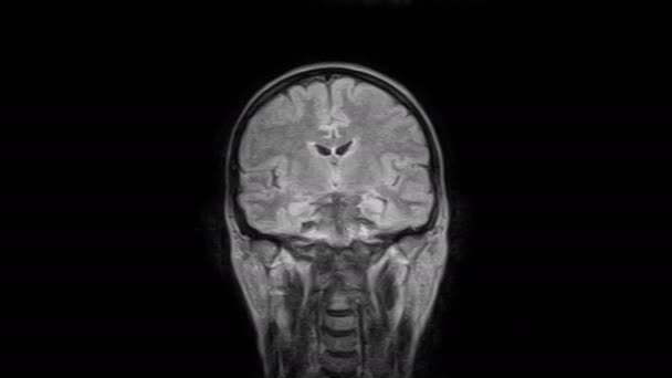 Brain MRI, head scans and tumor detection. Diagnostic medical tool — Stock Video