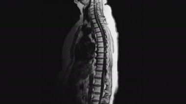 Metastaz tespiti için kadın organlarının ameliyat sonrası MR 'ı..