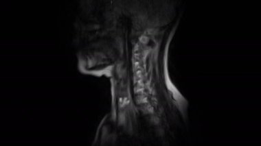 Boyun omurgasının saflaştırılmış MR 'ı, çıkıntı ve fıtık tespiti.