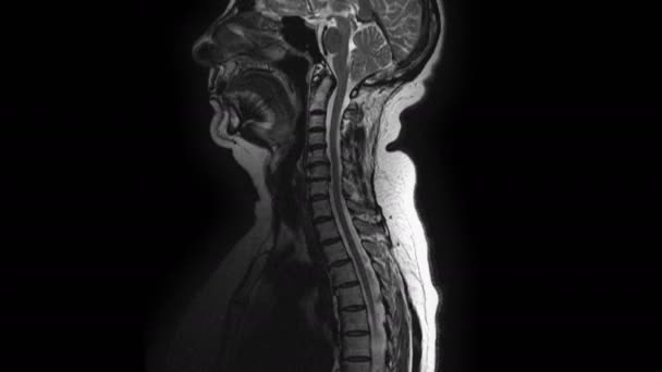 Női szervek posztoperatív MRI-je metasztázisok kimutatása céljából. — Stock videók