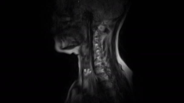 Aufgereinigte MRT der Halswirbelsäule, Erkennung von Vorwölbungen und Leistenbrüchen — Stockvideo
