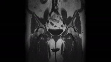 Metastaz tespiti için kadın organlarının ameliyat sonrası MR 'ı.