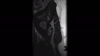 Metastaz tespiti için kadın organlarının ameliyat sonrası MR 'ı.