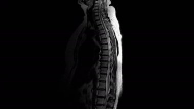 Metastaz tespiti için kadın organlarının ameliyat sonrası MR 'ı.