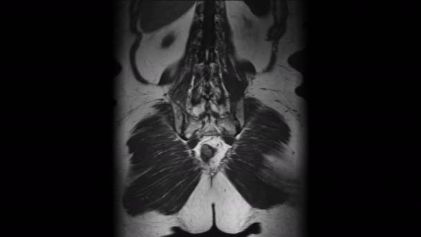 Postoperative MRT weiblicher Organe zum Nachweis von Metastasen — Stockvideo