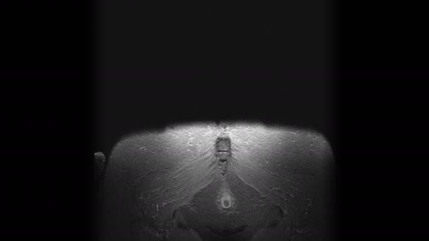 女性器官术后MRI检查转移性病变 — 图库视频影像