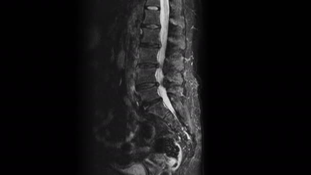 Postoperative MRT weiblicher Organe zum Nachweis von Metastasen — Stockvideo