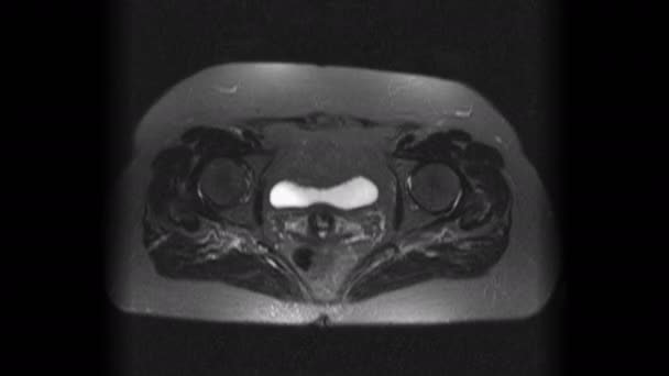 전이를 탐지하기 위한 여성 장기의 수술 후 MRI — 비디오
