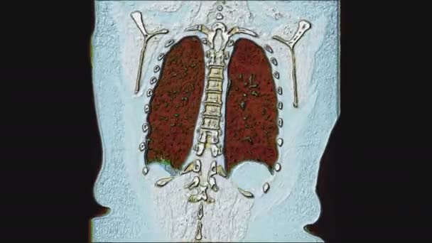 Color MRI of the lungs and bronchi, diagnosis of viral or covid-19 respiratory disease — Stock Video