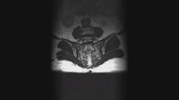 전이를 탐지하기 위한 수술 후의 여성 장기에 대한 거대 한 MRI — 비디오