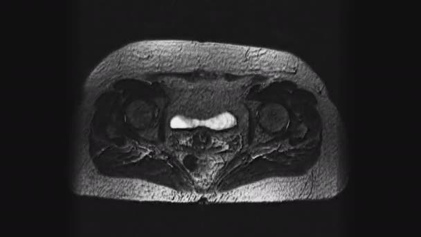 Postoperative voluminöse MRT weiblicher Organe zum Nachweis von Metastasen — Stockvideo