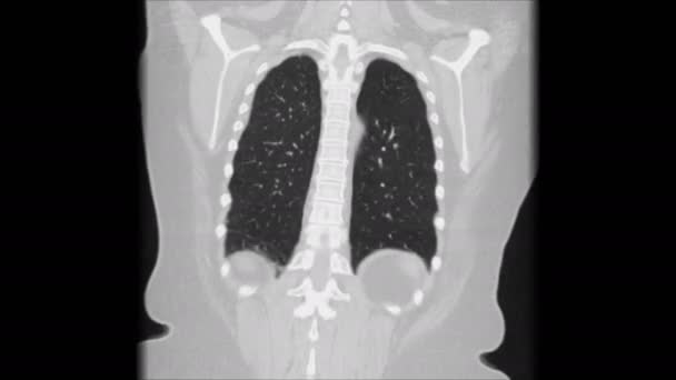 MRI of the lungs and bronchi, diagnosis of viral respiratory disease — Stock Video