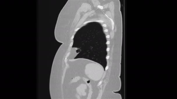 MRI of the lungs and bronchi, diagnosis of viral respiratory disease — Stock Video