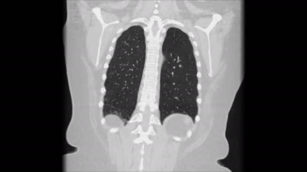 Čištěná MRI plic a průdušek, diagnóza virového respiračního onemocnění — Stock video