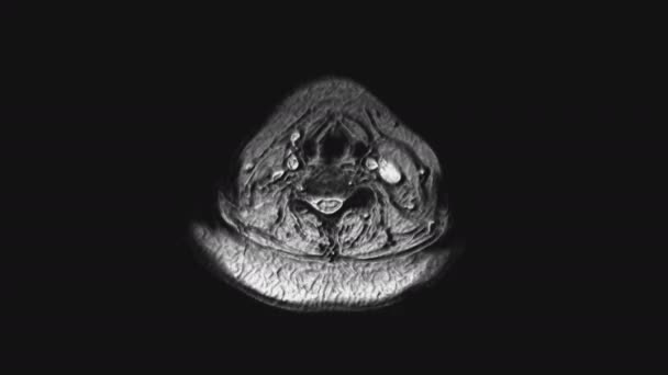 Postoperative voluminöse MRT weiblicher Organe zum Nachweis von Metastasen — Stockvideo