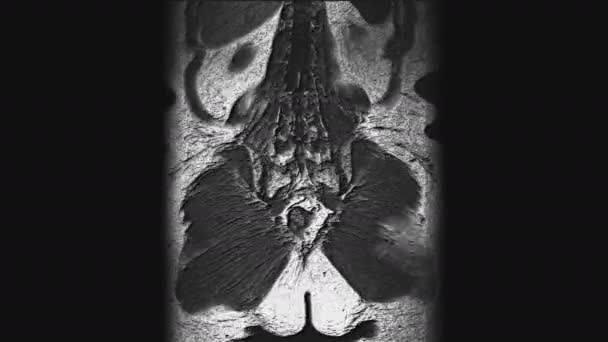 Resonancia magnética voluminosa postoperatoria de órganos femeninos para la detección de metástasis — Vídeos de Stock